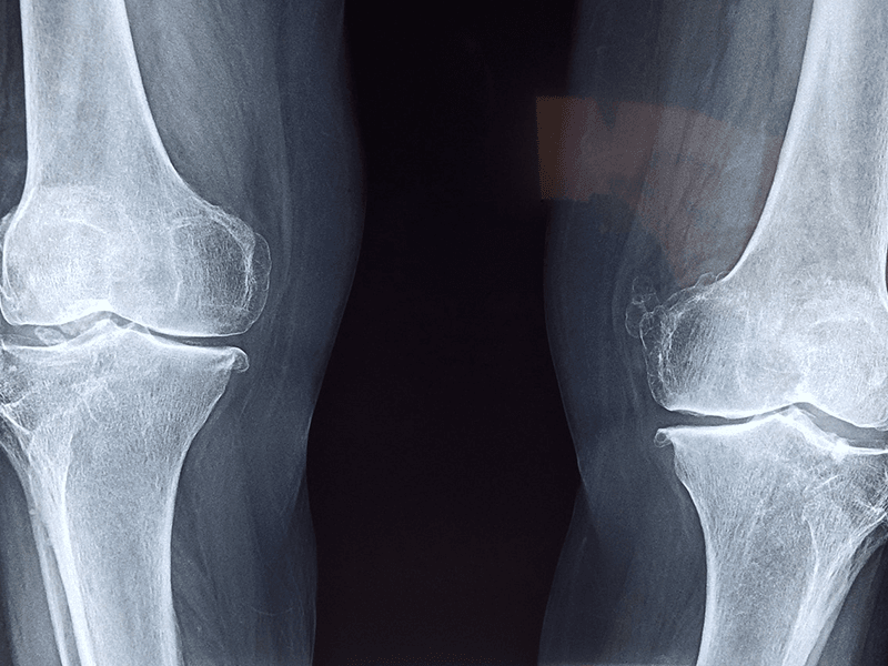 X-ray Healthy Knees